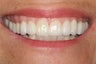 Full upper arch of veneers