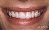 Porcelain Veneers
