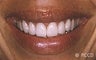 porcelain veneers