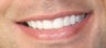 Veneers