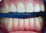 teeth whitening and dental veneers 