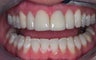 Porcelain veneers and crown 