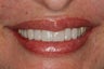 Porcelain Bridge and Veneers