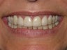 Veneers #7-10