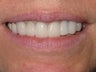 Dental Crown
