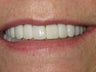 Veneers and Whitening