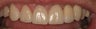 Porcelain Veneers
