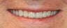  Porcelain veneer therapy