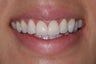Two central incisor porcelain veneers