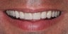 Veneers along with crowns