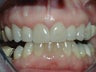 Porcelain Veneers