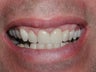 Porcelain Veneers