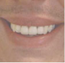 Porcelain Veneers