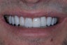 Crowns and Veneers
