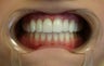 Upper arch make over with veneers and crowns