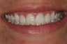 Simple Smile Design with gum lift and porcelain veneers