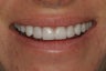 Smile Makeover with Minimal-Prep and No-Prep Veneers