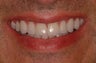 Complete  Smile Makeover