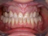 Porcelain Veneers and Porcelain Crowns