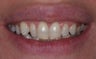 Veneer therapy
