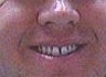 Porcelain Veneers