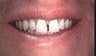 Porcelain Veneers