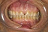 Diastema (Gap) Closure