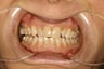 Gumline notches