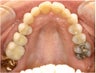 Natural All Porcelain Restorations