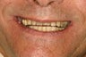 Full Smile Makeover