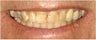 Porcelain Veneers