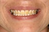 Developmental Discoloration