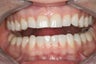 Whitening and Bonding