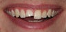 Single tooth veneer after trauma