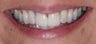 Peplacement of fractured poorly colored veneers