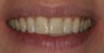 Two central incisor veneers to replace chipping discolored bonding