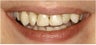 8 Veneers to a more confident smile