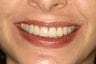 Tetracycline Stains treated with Veneers