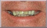 Porcelain Veneers