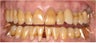 Closing black triangles between teeth