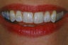 Porcelain Veneers