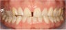 Closing Gap With Porcelain Veneers