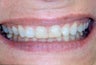 Porcelain Veneers