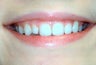 single veneer