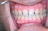 Porcelain veneers