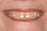 Full upper arch of veneers