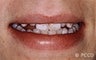 Porcelain Veneers