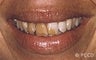 porcelain veneers