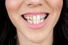 dental veneers