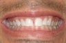 Veneers